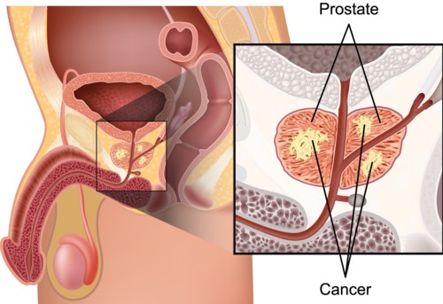 Read more about the article PROSTAT KANSERİ RİSKİNİ AZALTMAK İÇİN 9 İPUCU