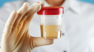 İdrarda Kan Görülmesi (Hematüri): Neden Olur, Ne Yapılmalı?