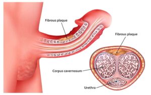 Peyronie Hastalığı Nedir?