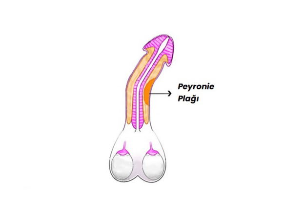 You are currently viewing Peyronie Hastalığı ve Ameliyatsız Tedavi Yöntemleri