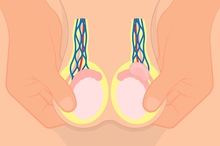 You are currently viewing Testis Kanseri Ameliyatı