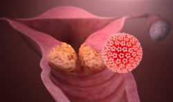HPV HPV