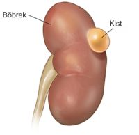 bobrek_kisti bobrek_kisti