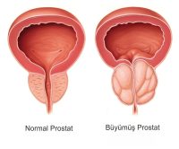 prostat